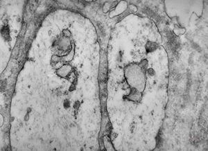 M,1y. | neuroblastoma - submandibular region